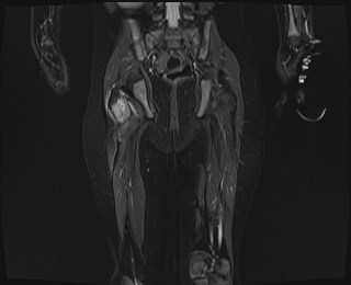File:Neuroblastoma with bone metastases (Radiopaedia 67080-76414 Coronal STIR 17).jpg