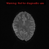 File:Neurofibromatosis type 1 with optic nerve glioma (Radiopaedia 16288-15965 Axial DWI 32).jpg