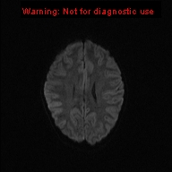 File:Neurofibromatosis type 1 with optic nerve glioma (Radiopaedia 16288-15965 Axial DWI 56).jpg