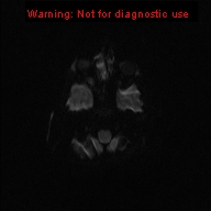 File:Neurofibromatosis type 1 with optic nerve glioma (Radiopaedia 16288-15965 Axial DWI 67).jpg