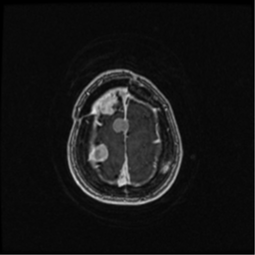 Neurofibromatosis type 2 (Radiopaedia 45229-49244 Axial T1 C+ 102).png