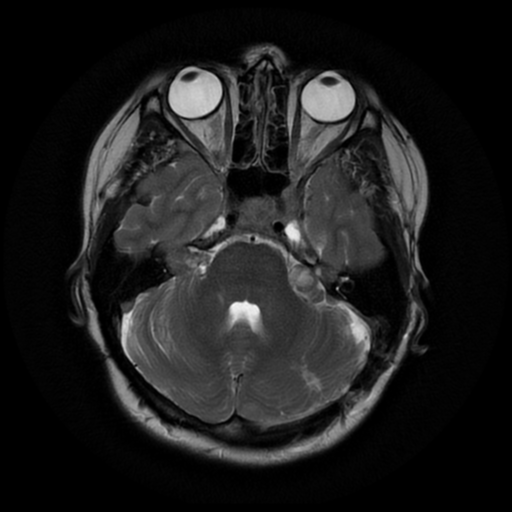 File:Neurofibromatosis type 2 (Radiopaedia 45229-49247 Axial T2 7).png