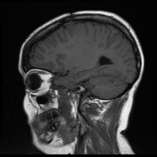 File:Neurofibromatosis type 2 (Radiopaedia 45229-49247 Sagittal T1 6).png