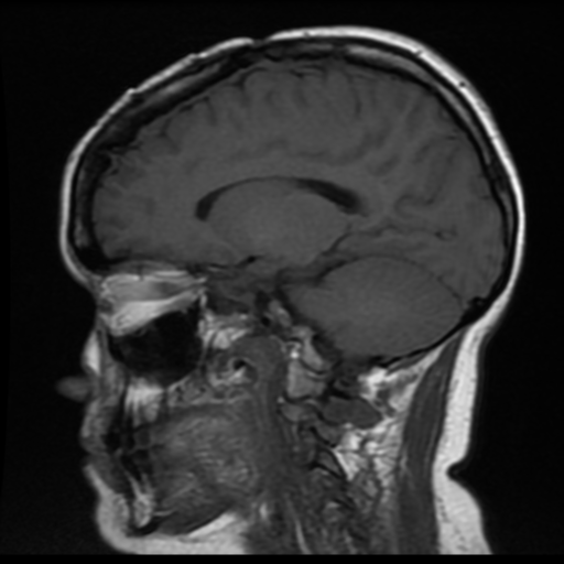 File:Neurofibromatosis type 2 (Radiopaedia 45229-49247 Sagittal T1 8).png
