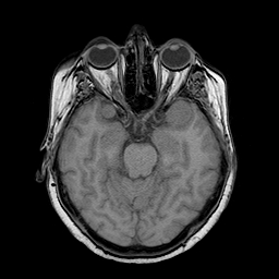 File:Neurofibromatosis type 2 (Radiopaedia 8713-9518 Axial T1 16).jpg