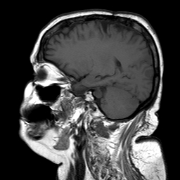 File:Neurofibromatosis type 2 (Radiopaedia 8713-9518 Sagittal T1 7).jpg