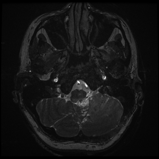 Neurofibromatosis type 2 - bilateral acoustic neuromata (Radiopaedia 40060-42566 Axial FIESTA 12).png