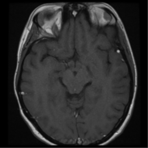 File:Neurofibromatosis type 2 - bilateral acoustic neuromata (Radiopaedia 40060-42566 Axial T1 14).png