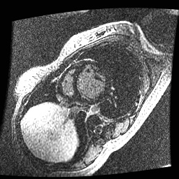 File:Non-compaction of the left ventricle (Radiopaedia 38868-41062 E 11).jpg