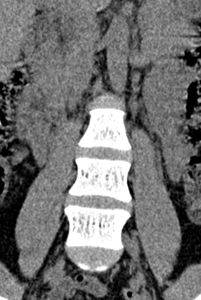 Normal CT lumbar spine (Radiopaedia 53981-60118 F 17).jpg