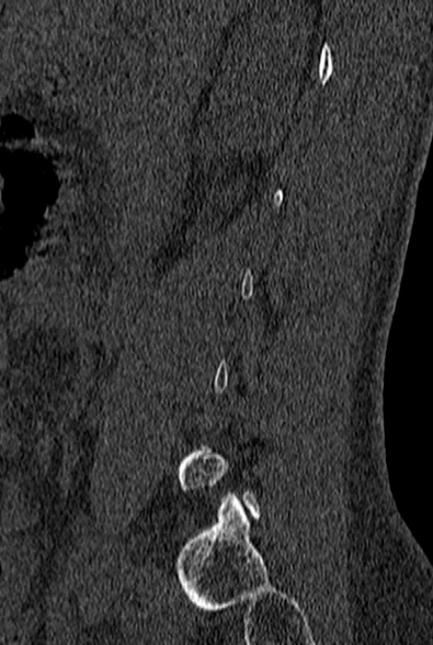 File:Normal CT lumbar spine (Radiopaedia 53981-60118 Sagittal bone window 14).jpg