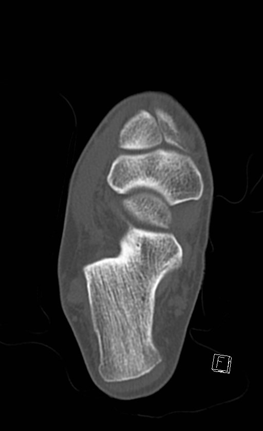 Normal CT of the ankle (Radiopaedia 47111-51658 Axial bone window 62).jpg
