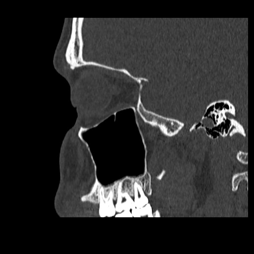 Normal CT paranasal sinuses (Radiopaedia 42286-45390 Sagittal bone window 25).jpg