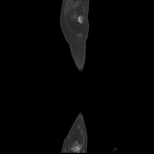 Normal CT tibia and fibula (Radiopaedia 51195-56848 Coronal non-contrast 20).jpg