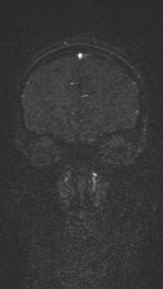 Normal MRI brain with MRV- teenager (Radiopaedia 49425-54553 Coronal MRV 56).jpg