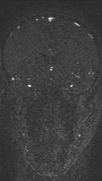 Normal MRI brain with MRV- teenager (Radiopaedia 49425-54553 Coronal MRV 95).jpg