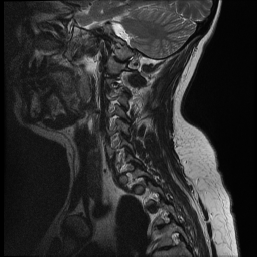 File:Normal cervical and thoracic spine MRI (Radiopaedia 35630-37156 Sagittal T2 11).png