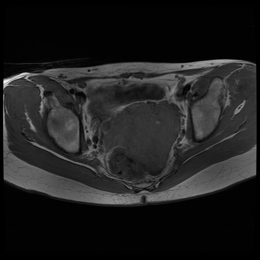 File:Normal female pelvis MRI (retroverted uterus) (Radiopaedia 61832-69933 Axial T1 18).jpg