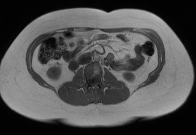 File:Normal liver MRI with Gadolinium (Radiopaedia 58913-66163 Axial T1 in-phase 7).jpg