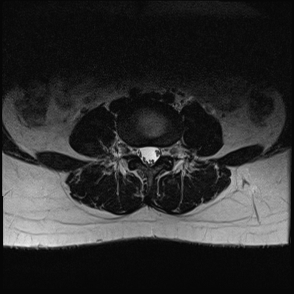 File:Normal lumbar spine MRI- 3 T (Radiopaedia 53280-59250 Axial T2 16).jpg