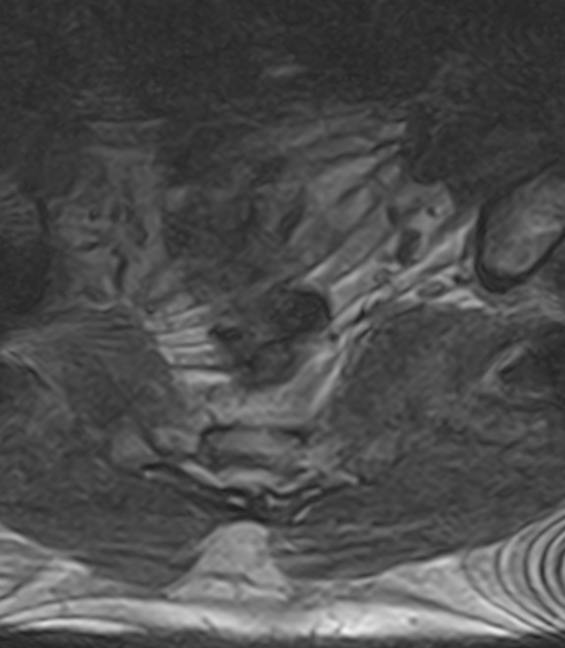 Normal lumbar spine MRI - low-field MRI scanner (Radiopaedia 40976-43699 Axial T2 105).jpg