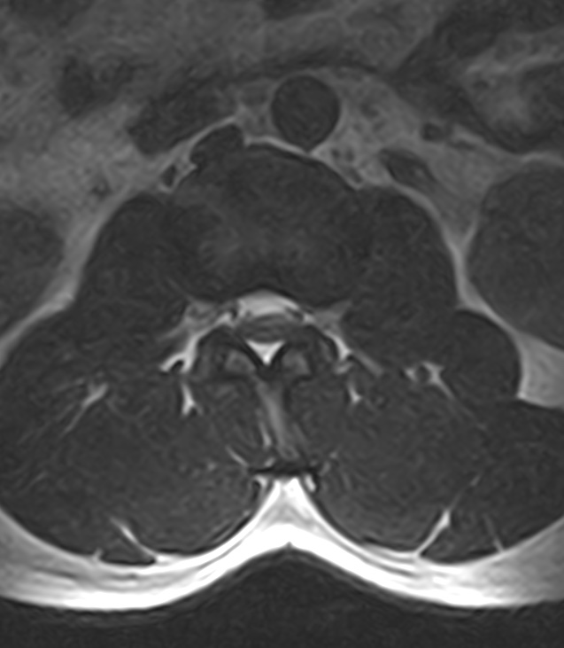 Normal lumbar spine MRI - low-field MRI scanner (Radiopaedia 40976-43699 Axial T2 33).jpg