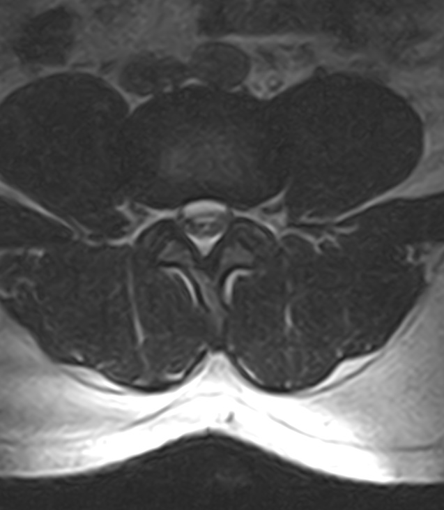 Normal lumbar spine MRI - low-field MRI scanner (Radiopaedia 40976-43699 Axial T2 62).jpg