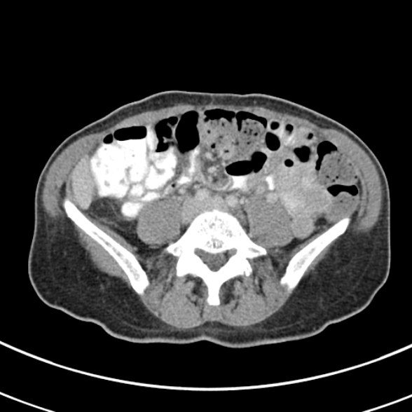 File:Normal multiphase CT liver (Radiopaedia 38026-39996 C 57).jpg