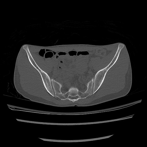 Normal pelvis CT (Radiopaedia 51471-57236 Axial bone window 40).jpg