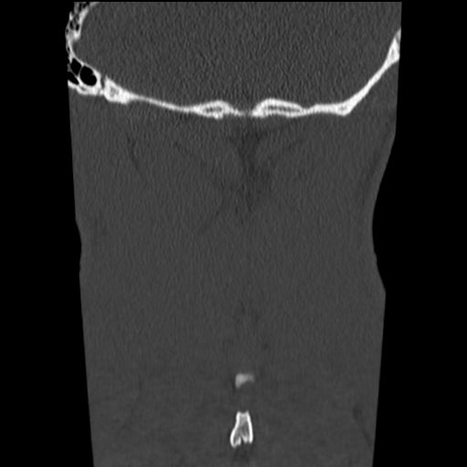 File:Normal trauma cervical spine (Radiopaedia 41017-43760 Coronal bone window 44).png