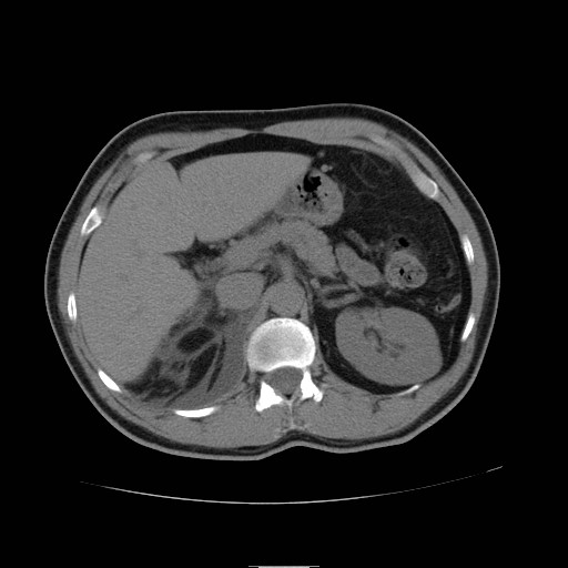 File:Obstructed kidney with perinephric urinoma (Radiopaedia 26889-27066 Axial non-contrast 12).jpg