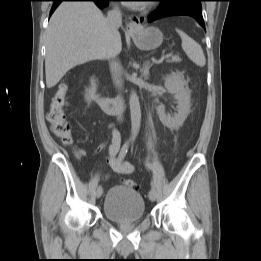 Obstructing renal calculus (Radiopaedia 29517-30016 Coronal non-contrast 28).jpg