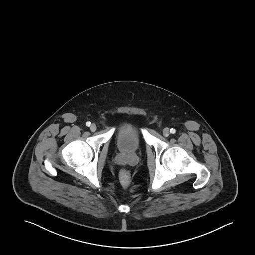 File:Obstructing sigmoid adenocarcinoma (Radiopaedia 58465-65619 A 157).jpg