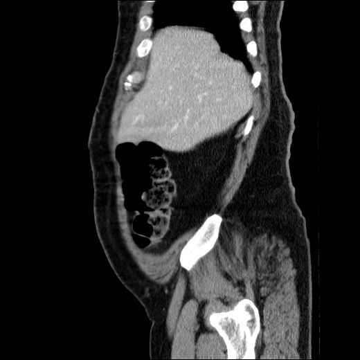 Obstructing ureteric calculus (Radiopaedia 49281-54373 C 74).jpg