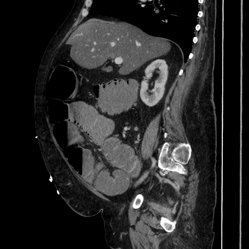 Obstructive colonic diverticular stricture (Radiopaedia 81085-94675 C 98).jpg