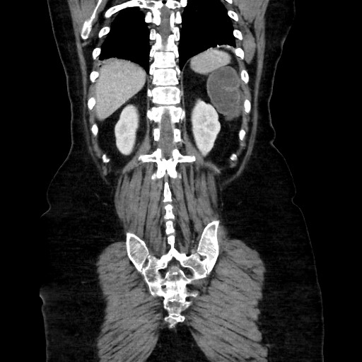 Obstructive distal colonic adenocarcinoma causing cecal perforation (Radiopaedia 86830-102989 C 138).jpg