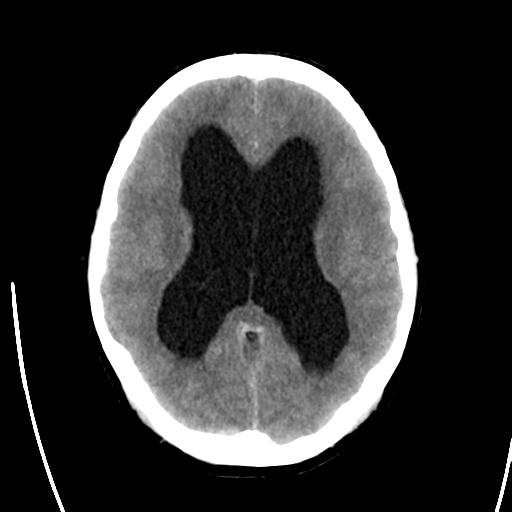 File:Obstructive hydrocephalus (Radiopaedia 30453-31119 Axial non-contrast 15).jpg
