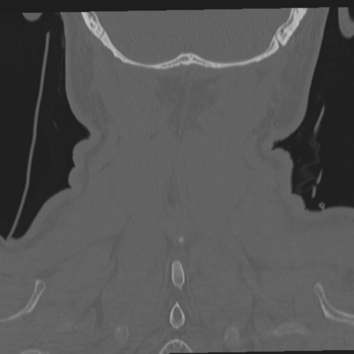 File:Occipital condyle fracture (Radiopaedia 33467-34517 Coronal bone window 62).png