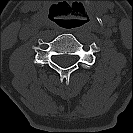 Occipital condyle fracture (type 1) (Radiopaedia 87670-104084 Axial bone window 39).jpg
