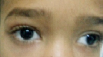 Severe ocular sequelae of congenital toxoplasmosis