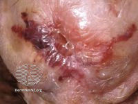 File:Penile lichen sclerosus (DermNet NZ 093-small).jpg