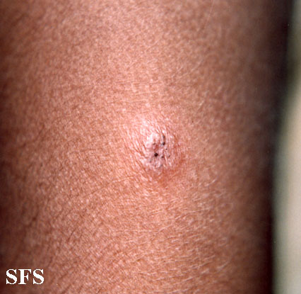 File:Sarcoidosis (Dermatology Atlas 3).jpg