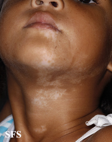 File:Vitiligo (Dermatology Atlas 43).jpg