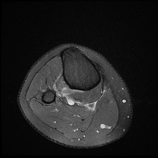 File:ACL acute full thickness tear - deep lateral femoral sulcus sign (Radiopaedia 38594-40740 Axial PD fat sat 27).jpg