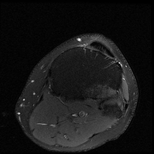 File:ACL and meniscal tears (Radiopaedia 79604-92797 Axial PD fat sat 21).jpg