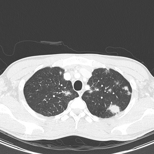 AIDS-related Kaposi sarcoma (Radiopaedia 85247-100811 Axial lung window 32).jpg