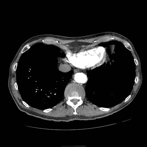 Abdominal aortic aneurysm (Radiopaedia 13341-13340 Axial C+ arterial phase 6).jpg