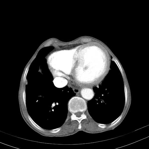 File:Abdominal aortic aneurysm (Radiopaedia 20827-20742 Axial C+ arterial phase 1).jpg