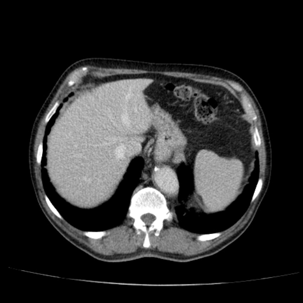 Abdominal aortic aneurysm (Radiopaedia 29248-29660 Axial C+ portal venous phase 12).jpg