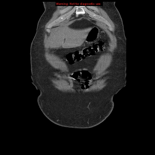 Abdominal aortic aneurysm (Radiopaedia 8190-9038 Coronal C+ arterial phase 14).jpg